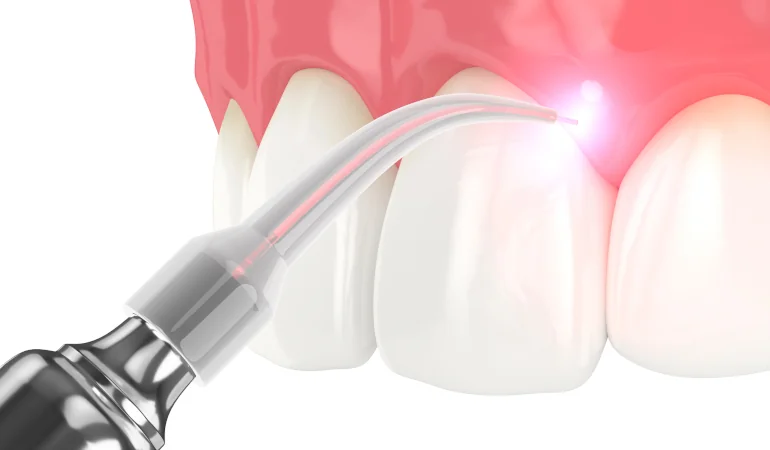 Best-Treatment-for-Gum-Disease