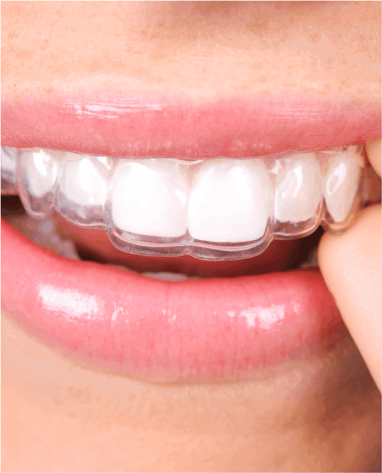 Clear retainer