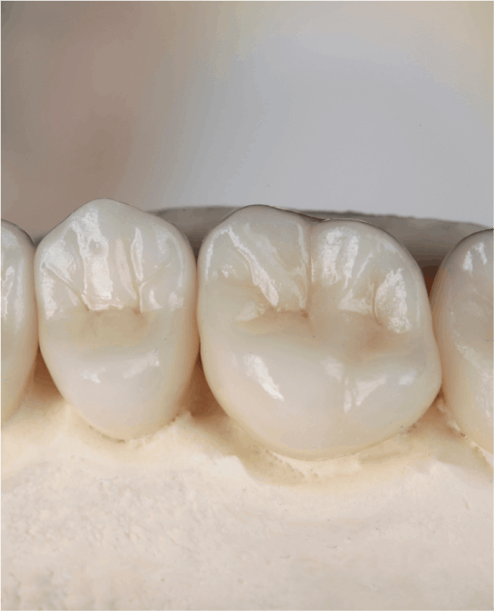 Dental Crowns
