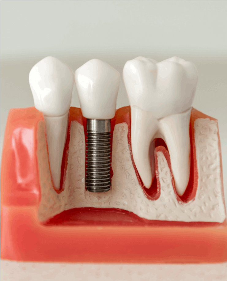 Dental Implant