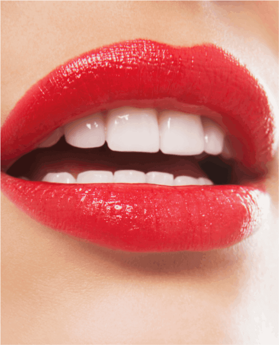 Dental Veneer