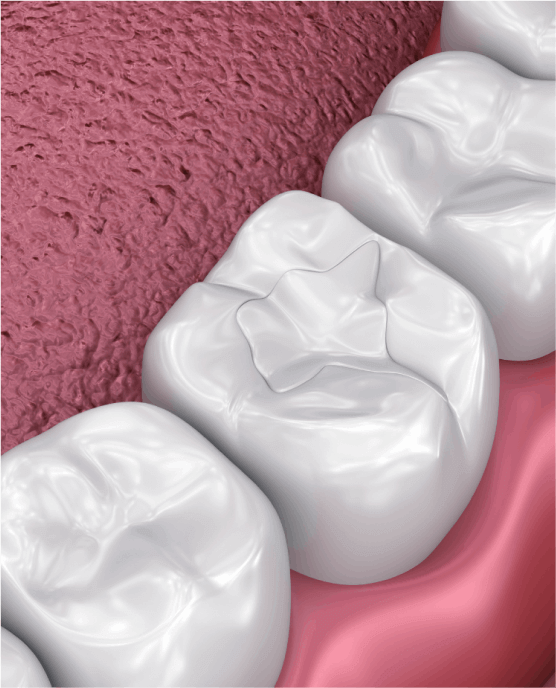Dental filling