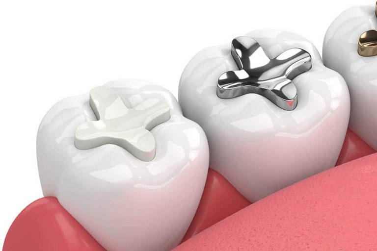 Safest Dental Fillings Amalgams Vs Composites Dental Designs