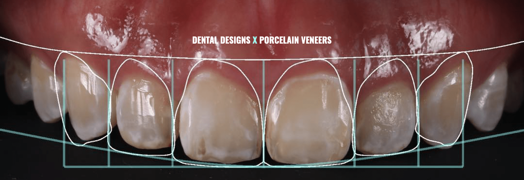 porcelain-veneers