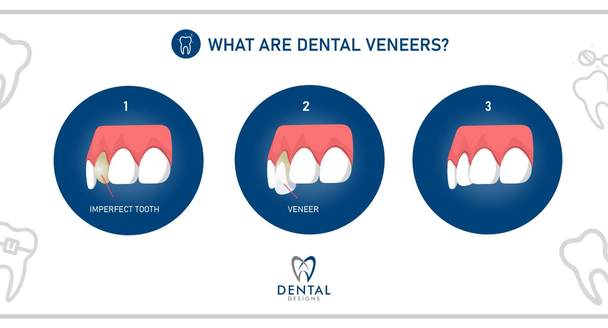 what-are-dental-veneers-