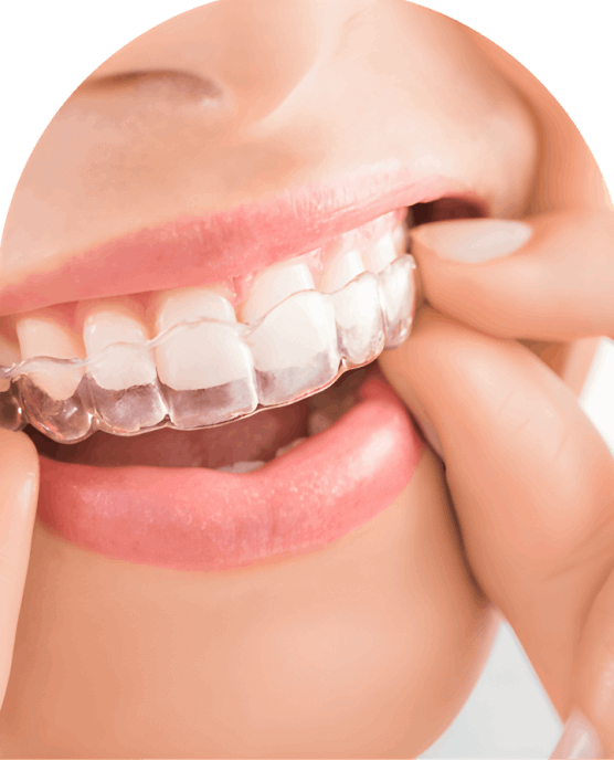 Invisalign