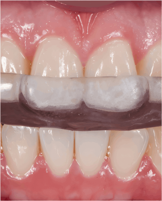 Mouth guard
