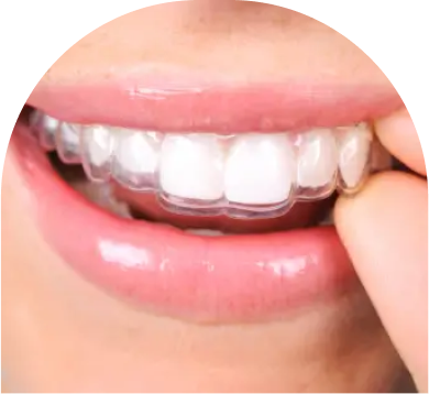 Clear Retainers | Crafted for Comfort and Precision at Dental Designs