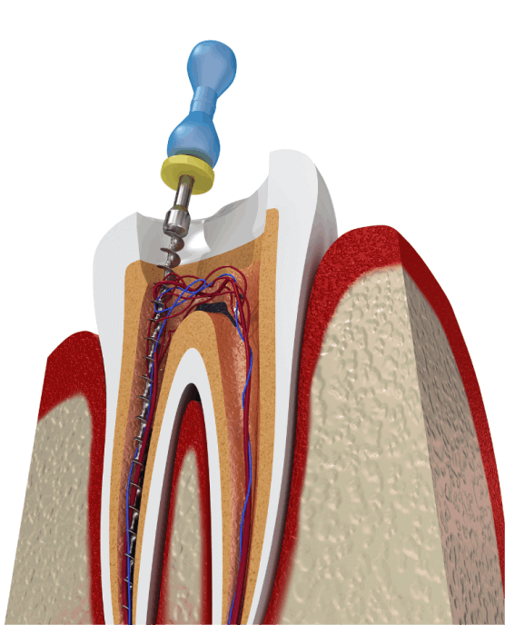 Root canal treatment