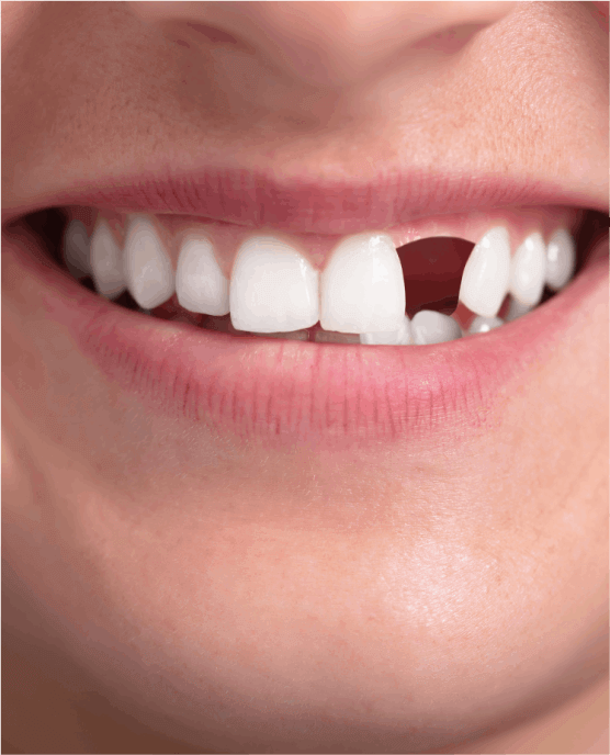 Teeth replacement