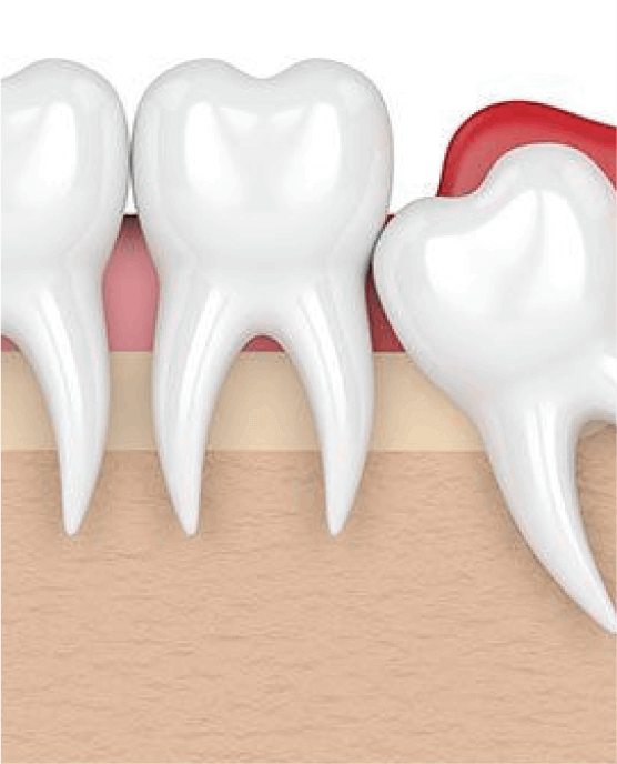 Wisdom teeth removal