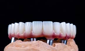 all on 4 ontop of implant coping