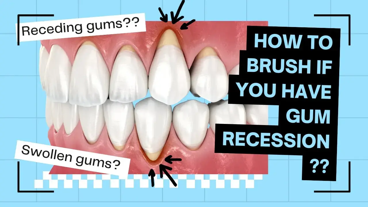 Why Do Gums Recede? A Hygienist’s Guide to Healthy Smiles