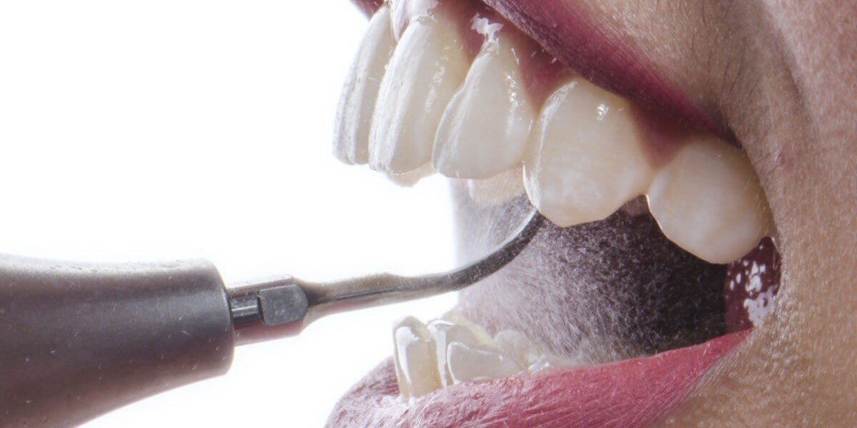 Airflow Cleaning | Guided Biofilm Therapy Explained | Dental Designs