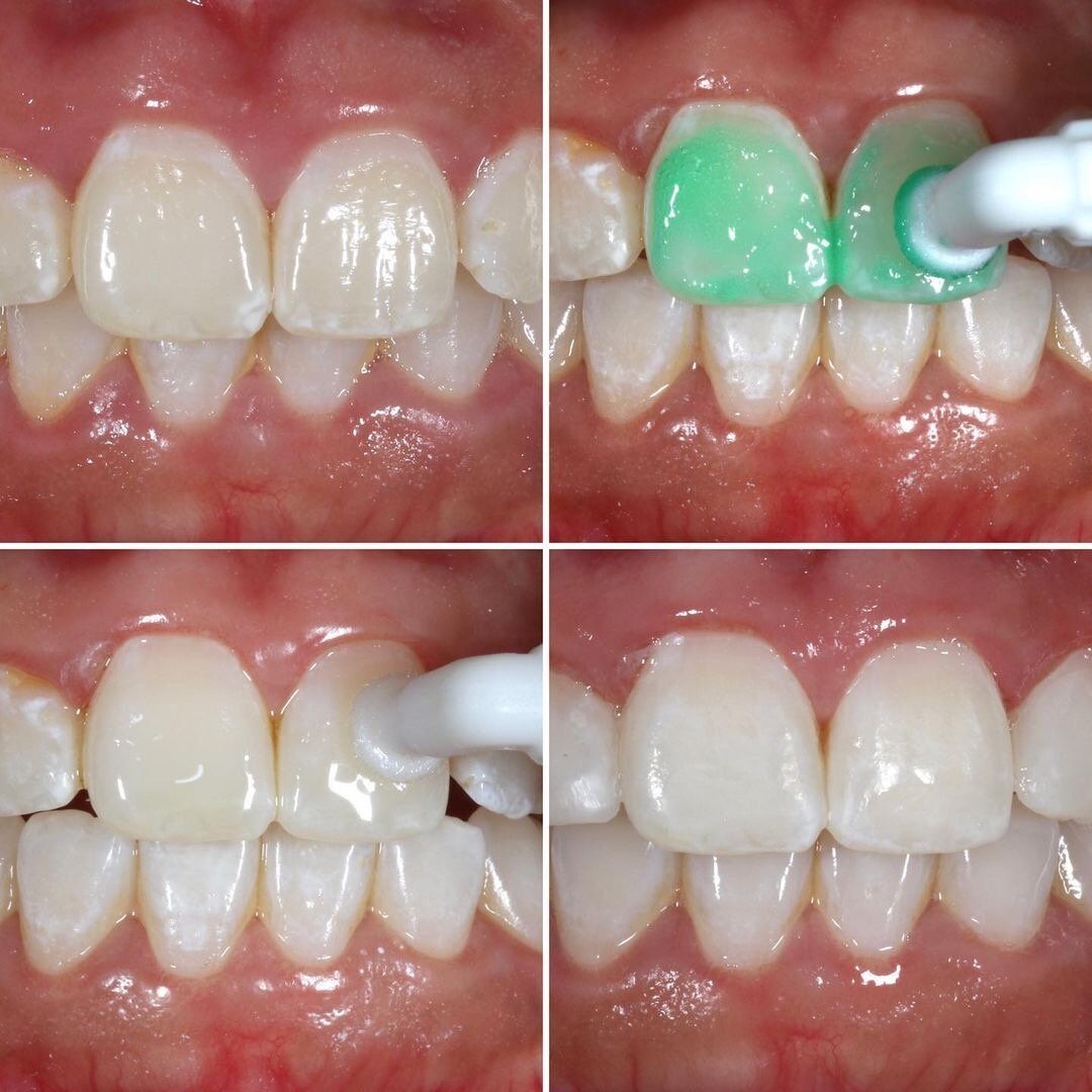 icon treatment steps