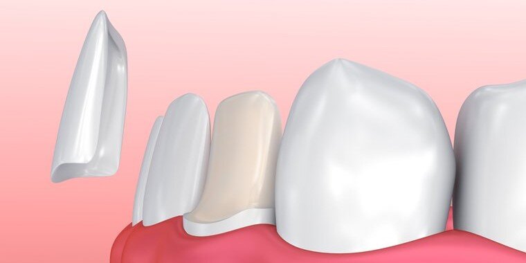 CAD-CAM Dental Porcelain Veneers In Singapore 2025 - Dental Designs