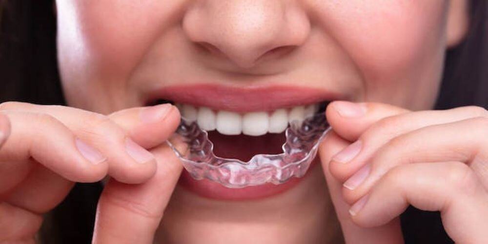 Invisalign Singapore Cost: Everything You Need to Know