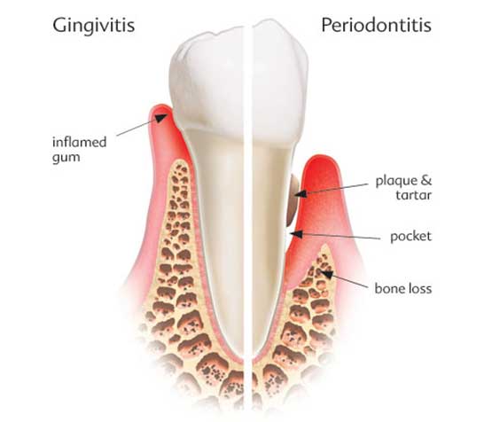 periodontal-disease-diagram