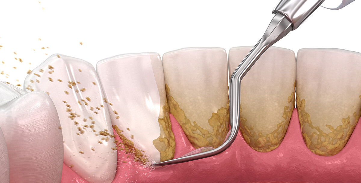 teeth scaling