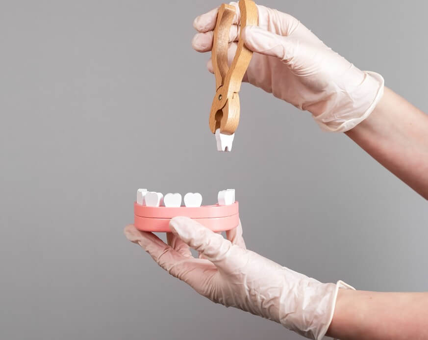 tooth extraction