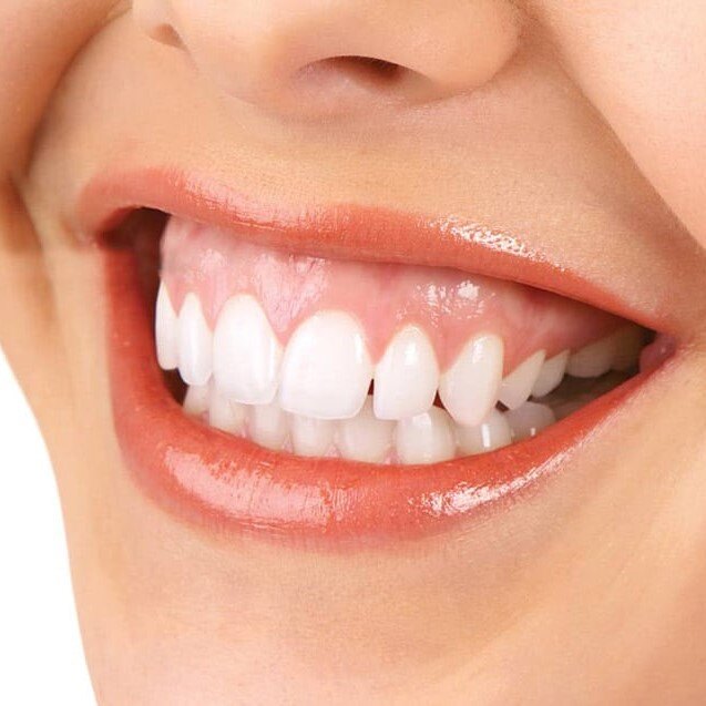 what-can-be-done-about-a-gummy-smile (1)